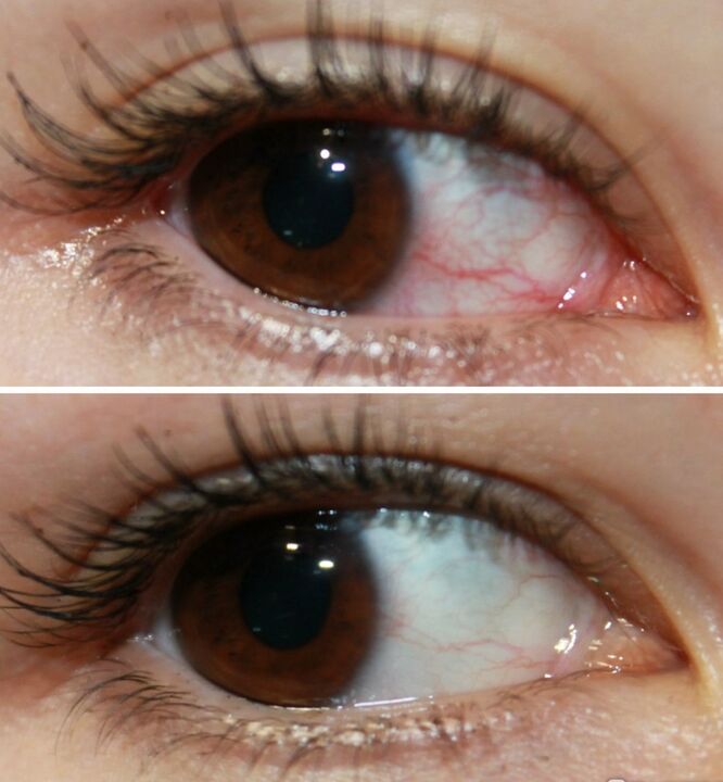 Ocuvit actúa moi rápido